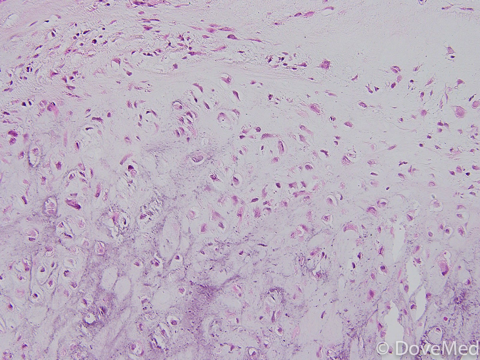 Pulmonary Chondroma