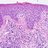 Microscopic pathology image of skin showing contact dermatitis with scattered eosinophils.