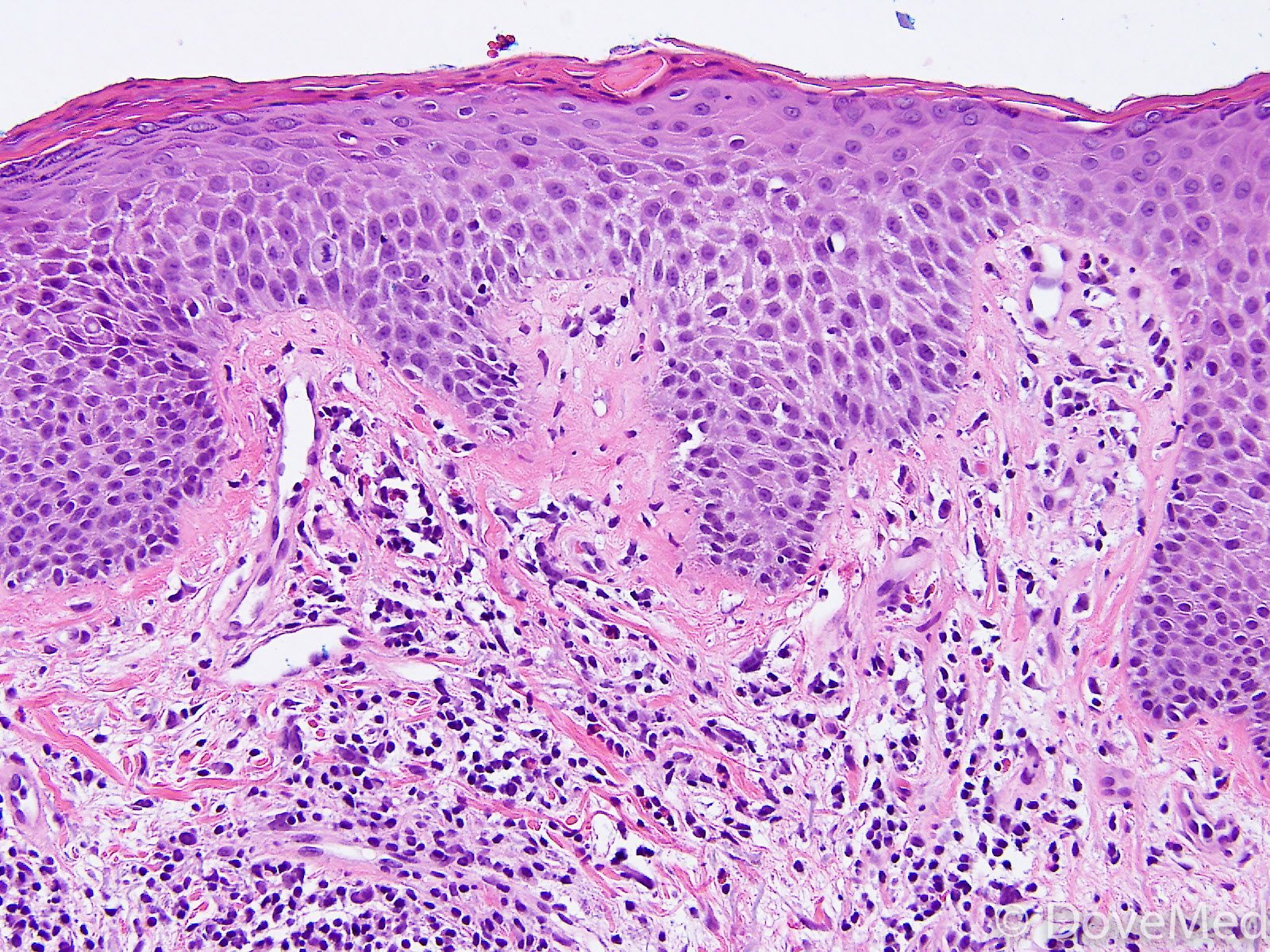 Atopic Dermatitis Histopathology