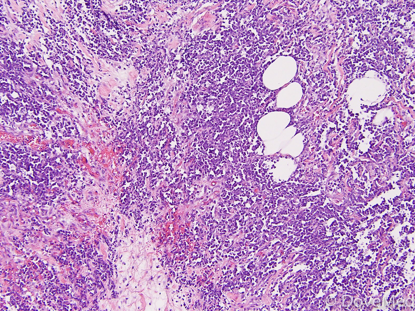 AIDSAssociated Burkitt and Burkittlike Lymphoma