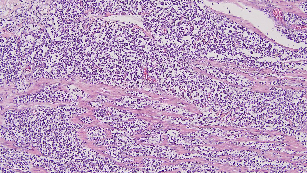 Burkitt Lymphoma of Small Intestine