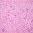 Microscopic pathology image showing high grade metaplastic carcinoma of breast showing infiltrating malignant glands in a dense osteoid like stroma.