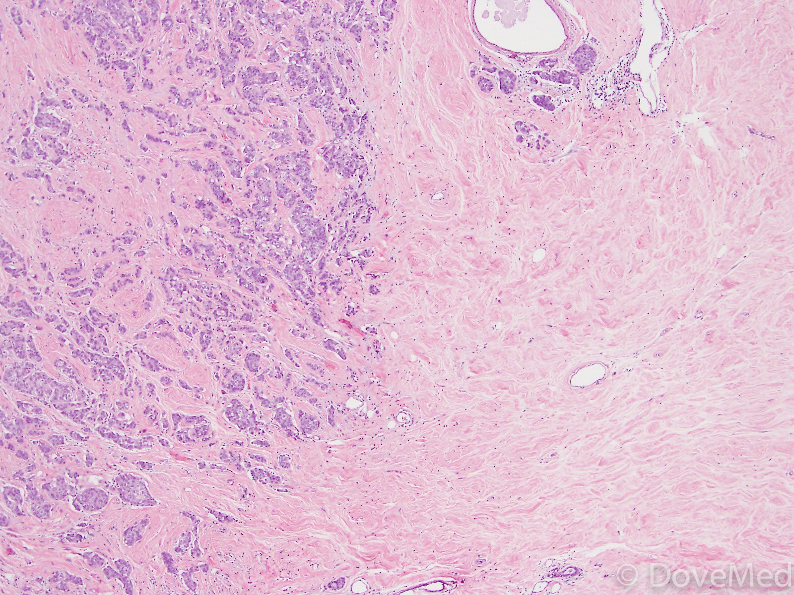 Invasive Ductal Carcinoma of Breast (NOS)