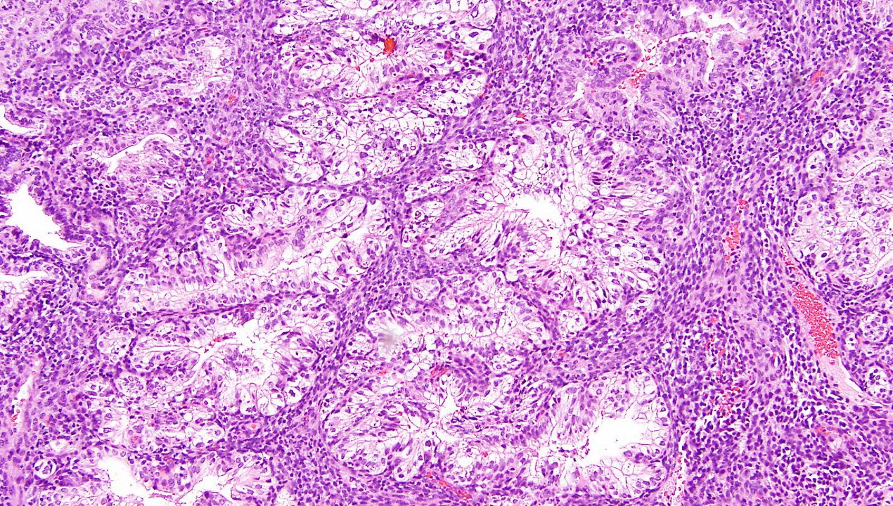 Clear Cell Carcinoma of Endometrium