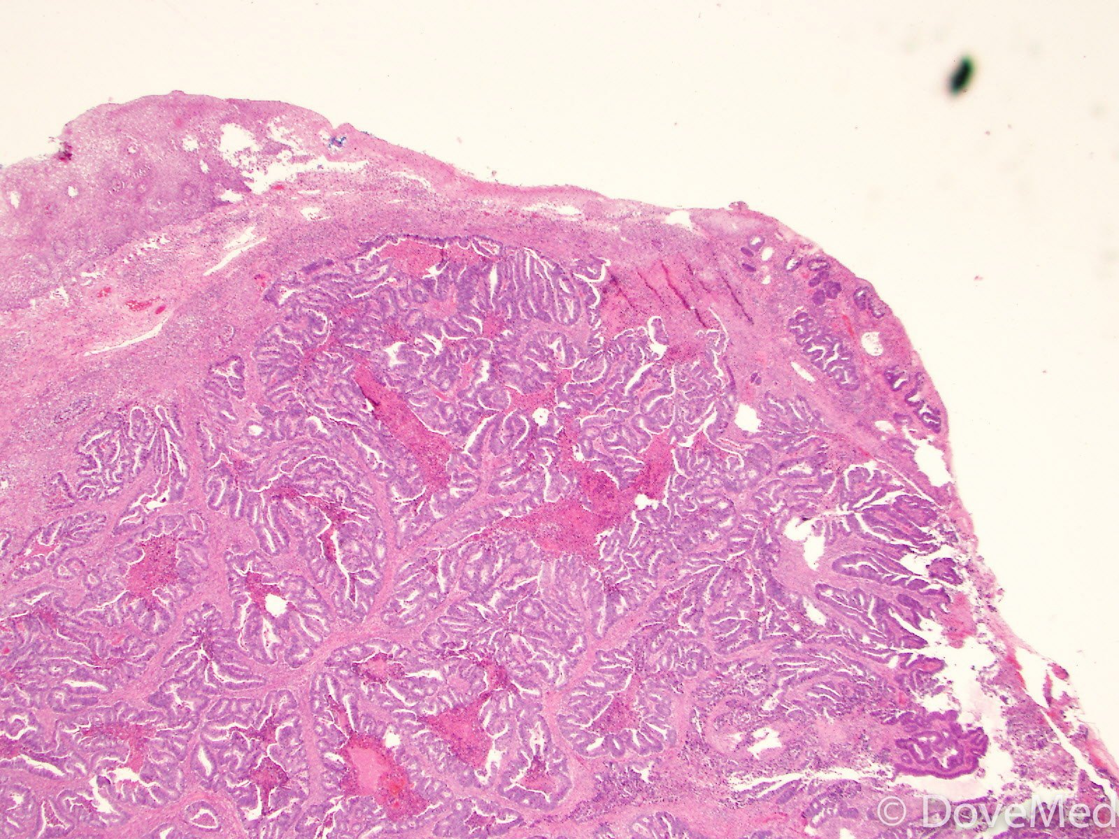 adenocarcinoma-of-cervix