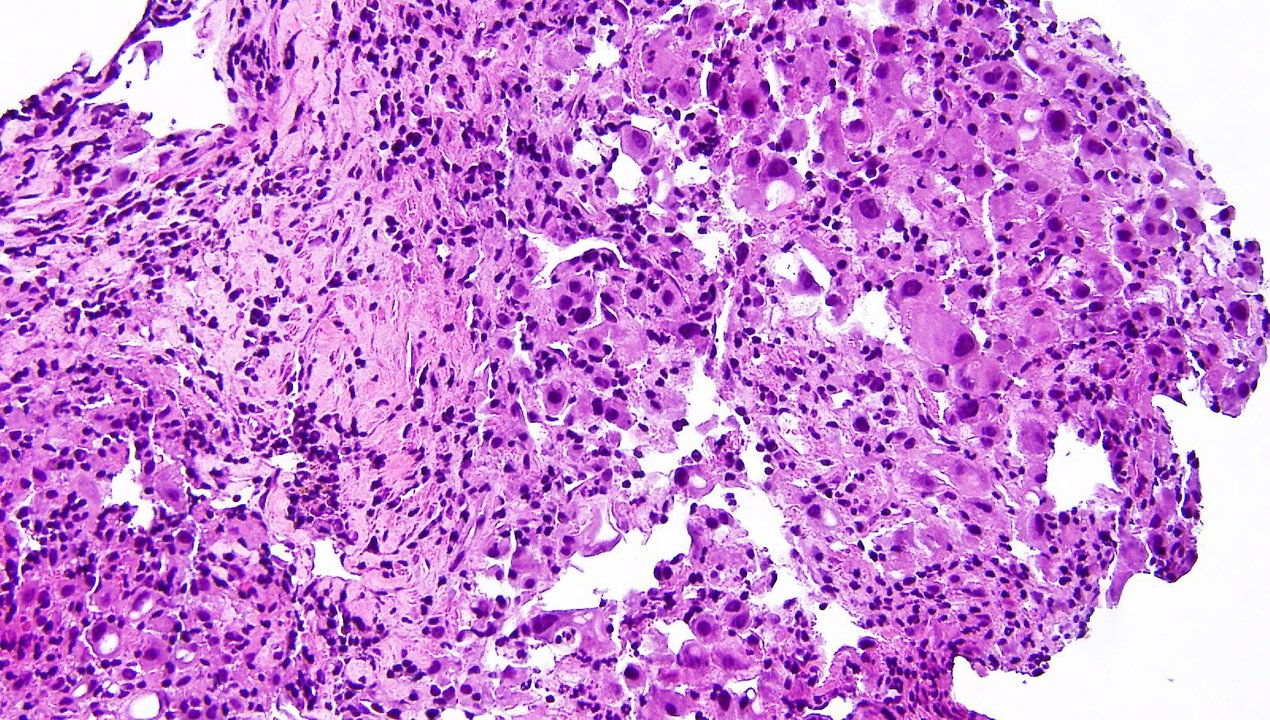 Minimally Invasive Adenocarcinoma Of Lung