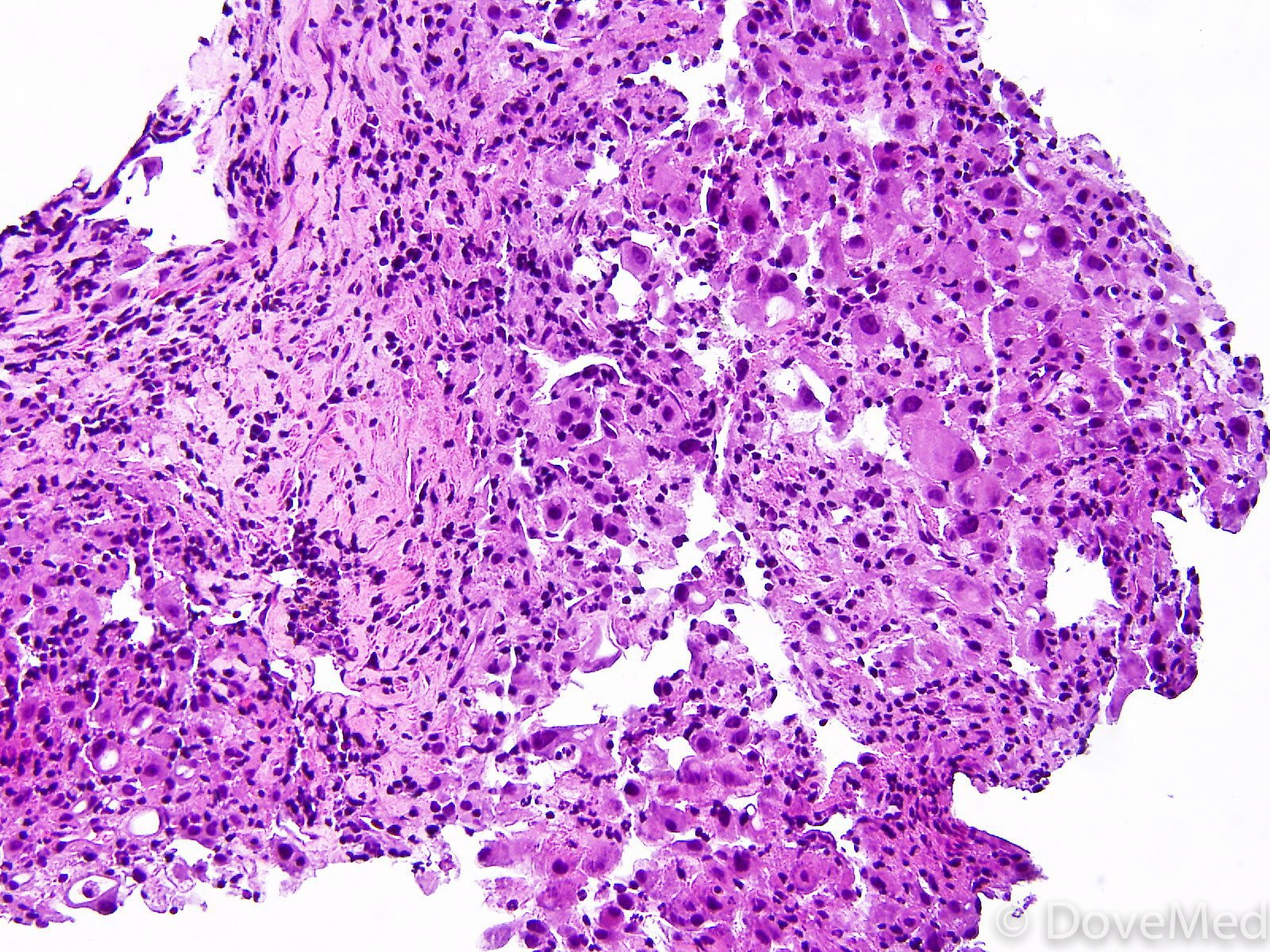 Minimally Invasive Adenocarcinoma of Lung