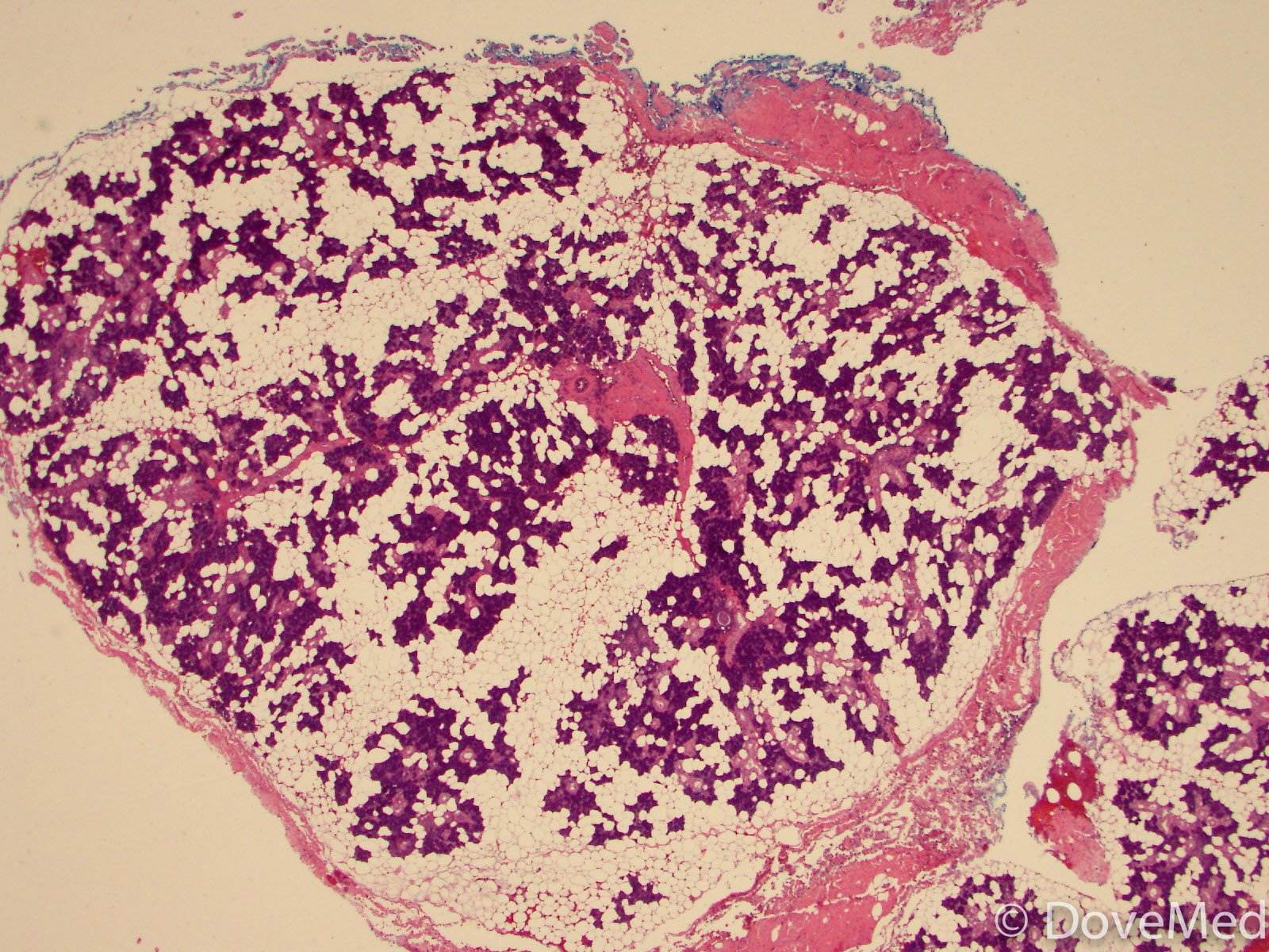 Salivary Gland Infections