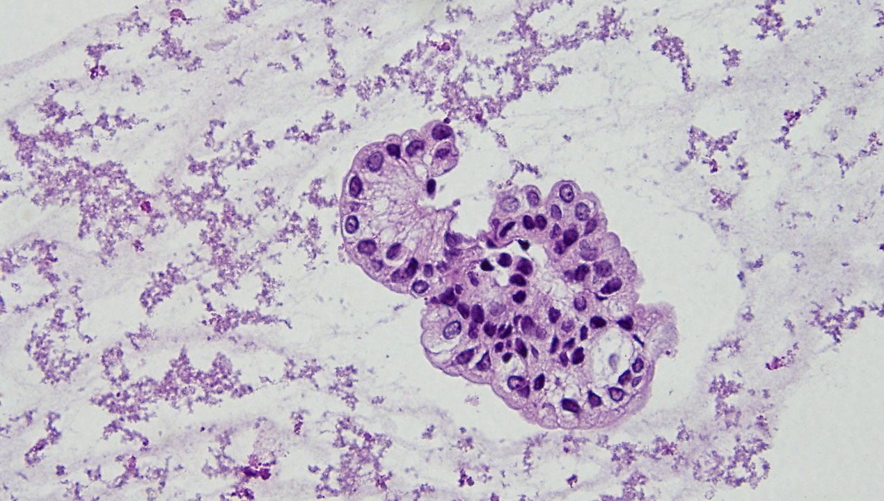 Common Cells In Peritoneal Fluid