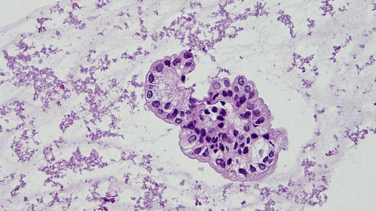 peritoneal-fluid-analysis