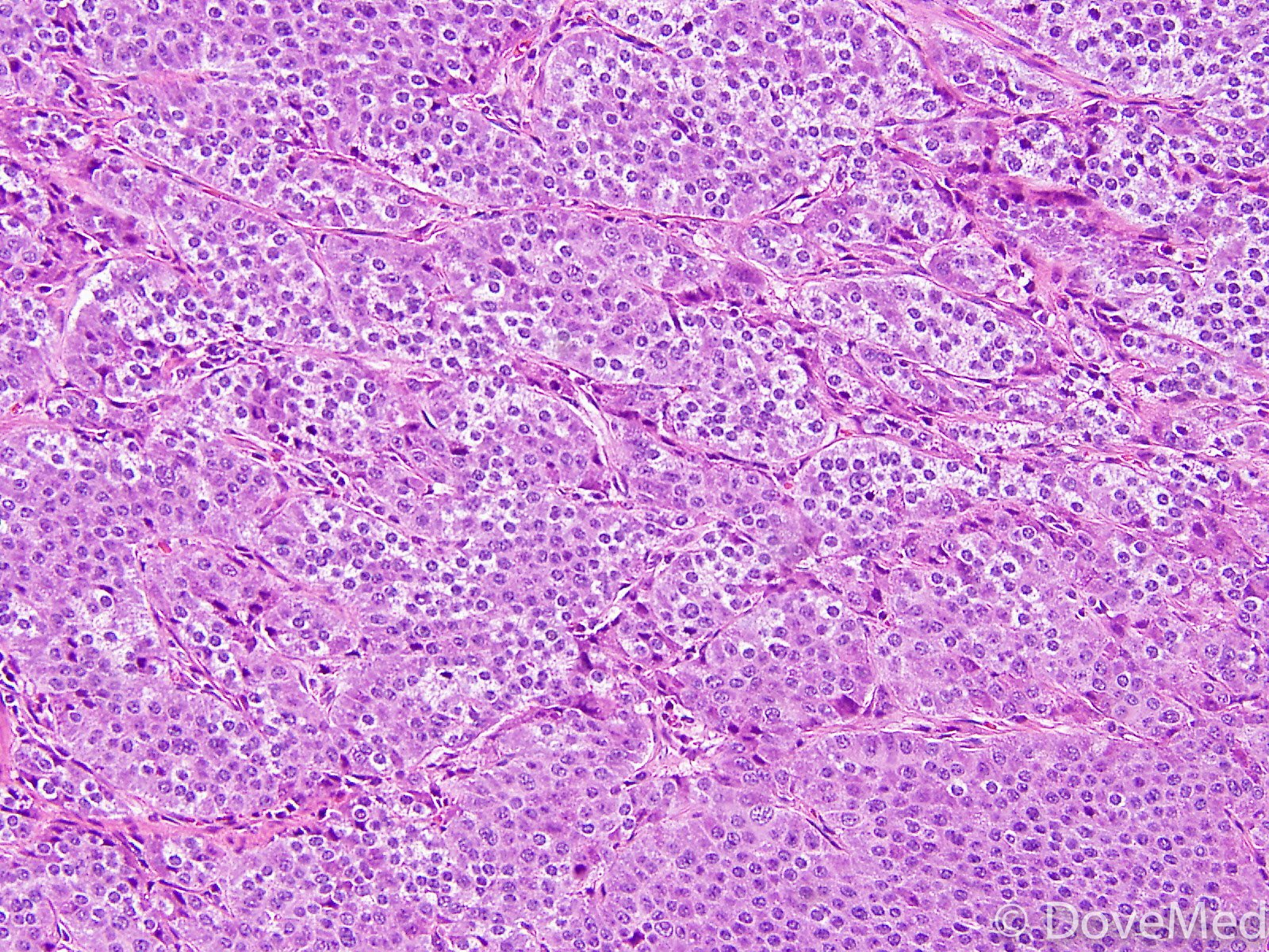 Atypical Glomus Tumor