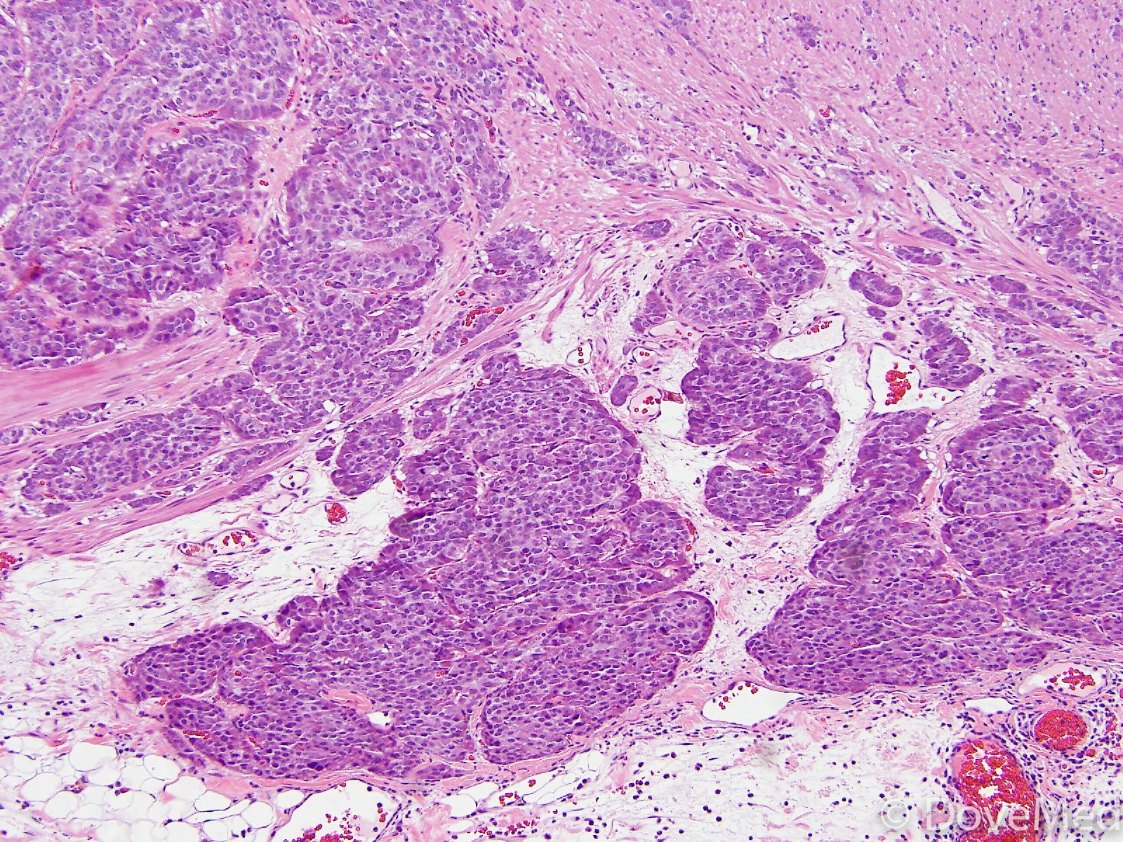 Carcinoid Tumor Of Lung 4179