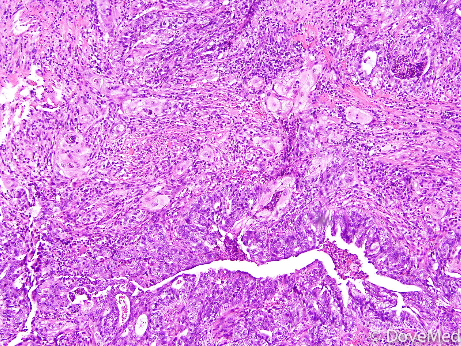 adenosquamous-carcinoma-of-uterine-cervix