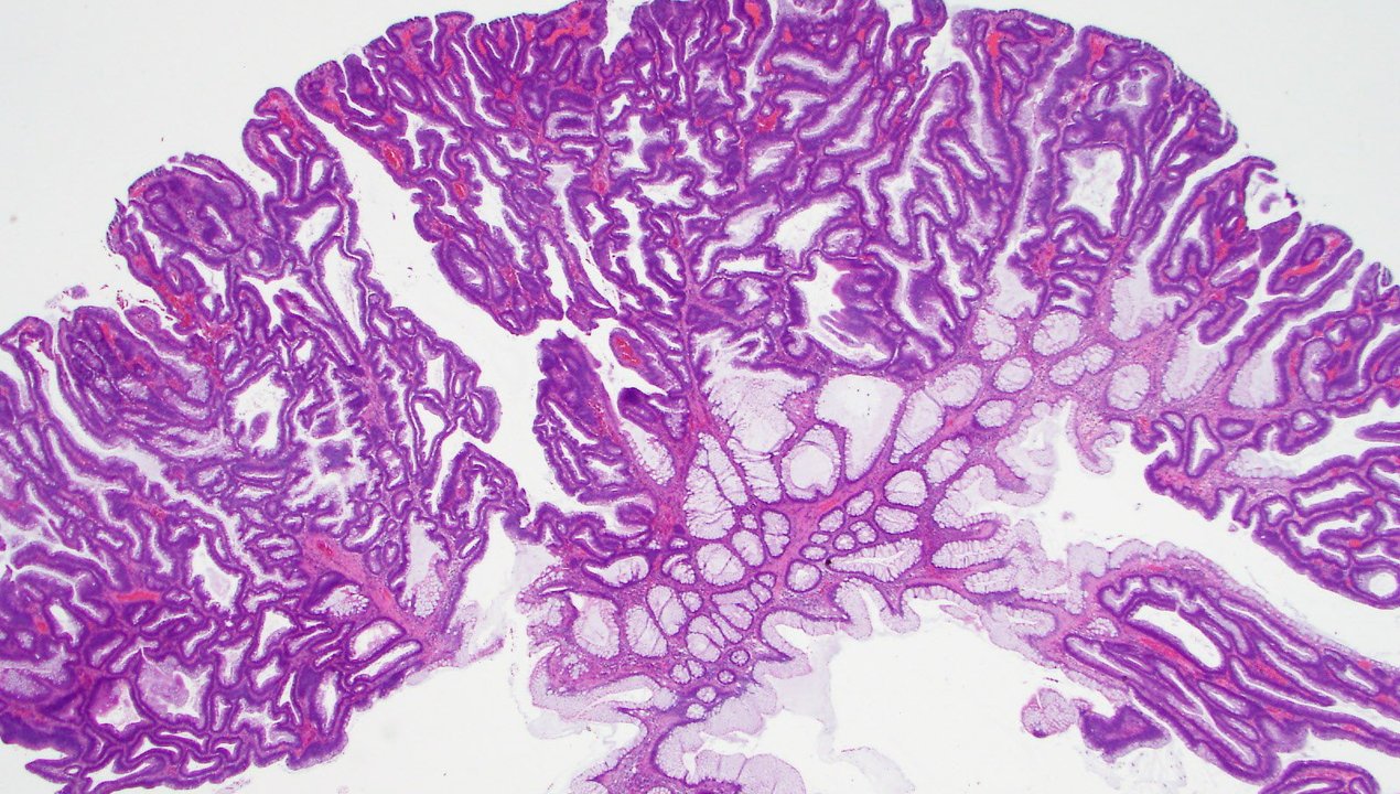 Tubular Adenoma of the Colon