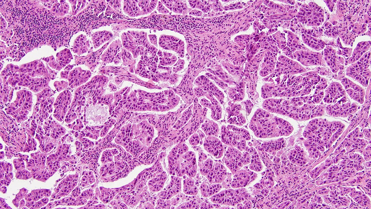 Papillary Adenocarcinoma Of Lung