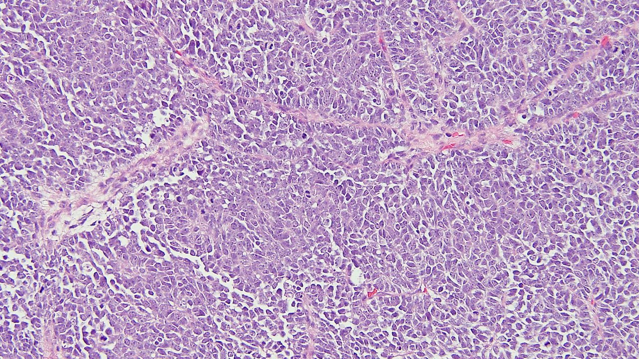 primary-cutaneous-ewing-s-sarcoma-pces