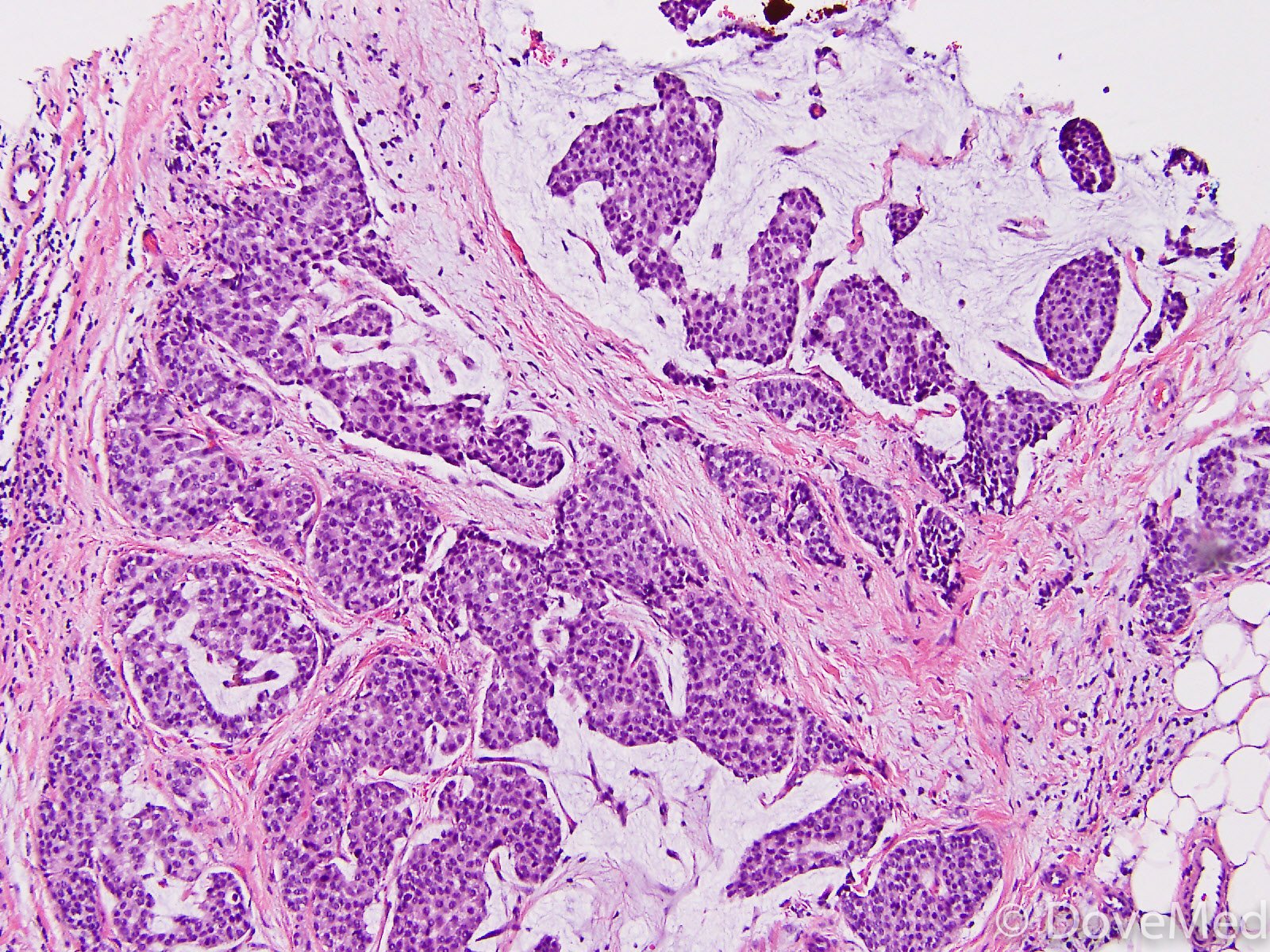 mucinous-carcinoma-of-breast