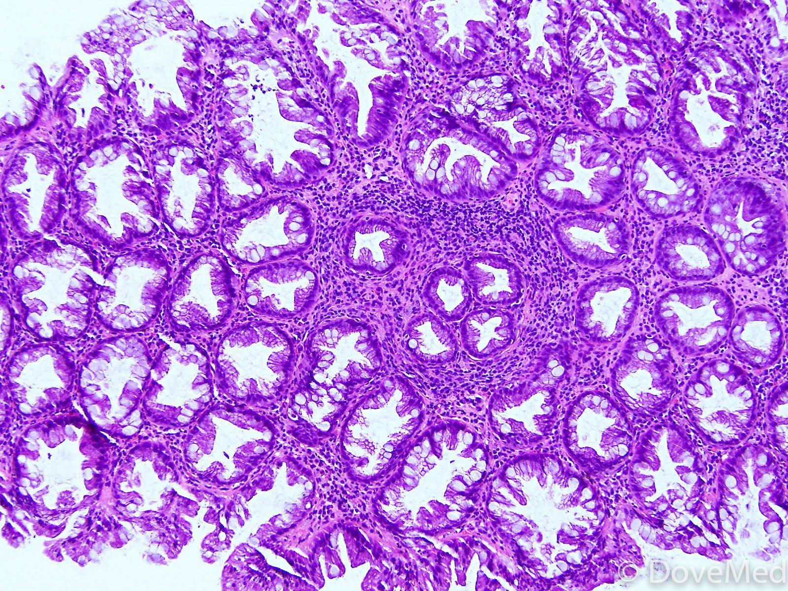 Hyperplastic Polyps Of The Colon