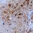 Microscopic pathology image showing metastatic prostate carcinoma to the bone which stains positive for Prostate Specific Antigen (PSA) on immuno stain.