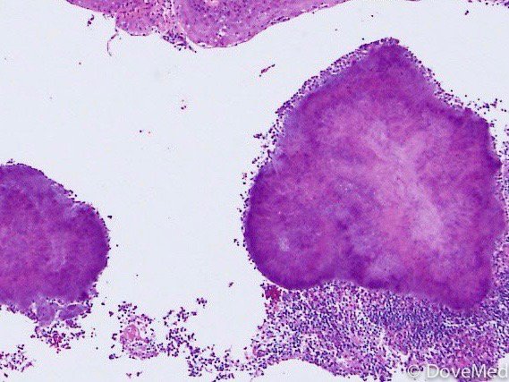 Cyst As Related To Actinomycosis - Pictures