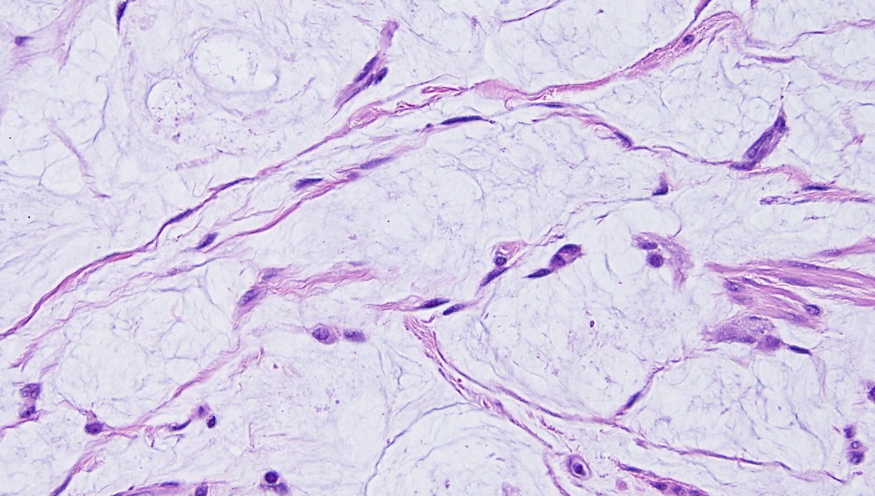 Nerve Sheath Myxoma