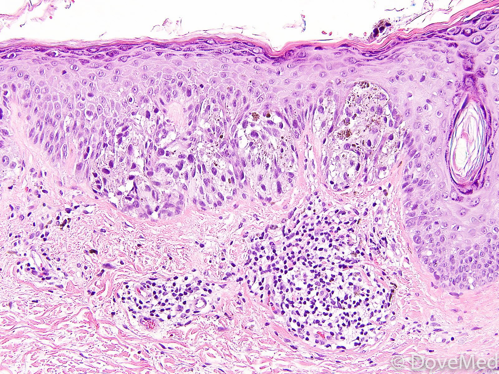 Melanoma In Situ Histology My XXX Hot Girl