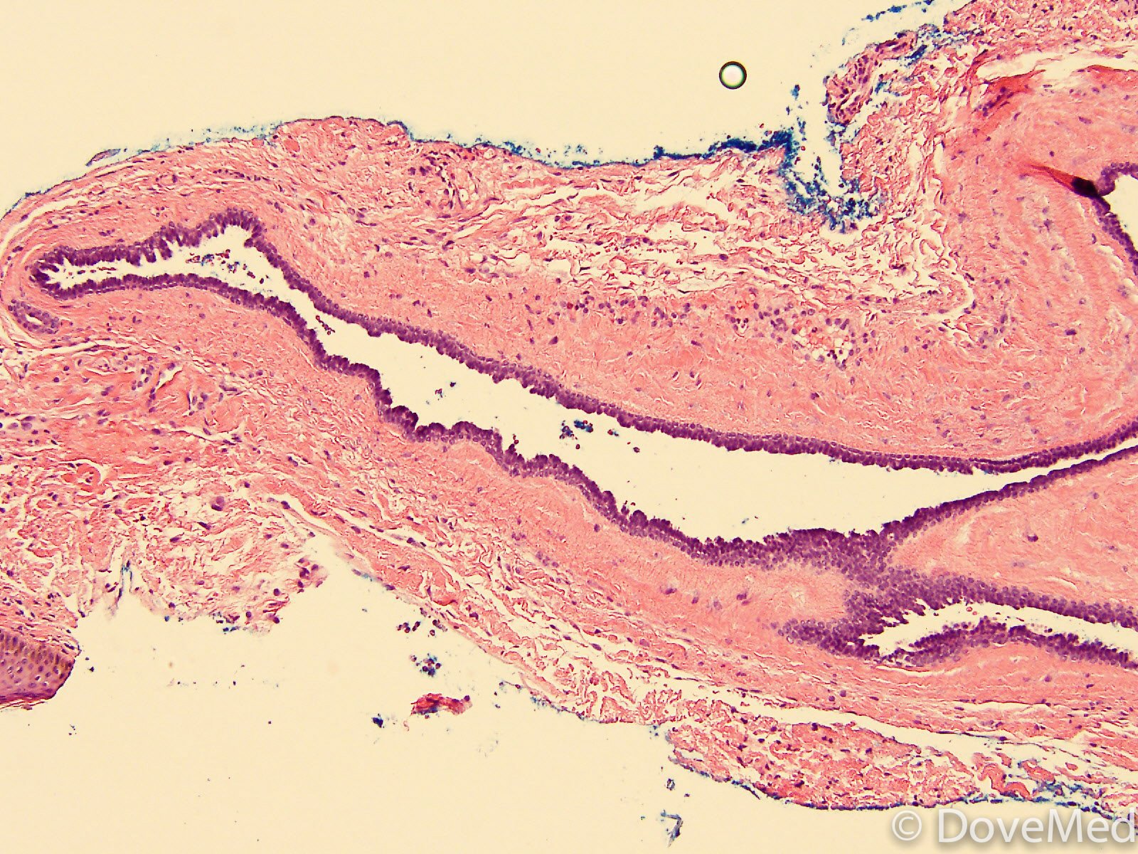 Eccrine Hidrocystoma of Skin