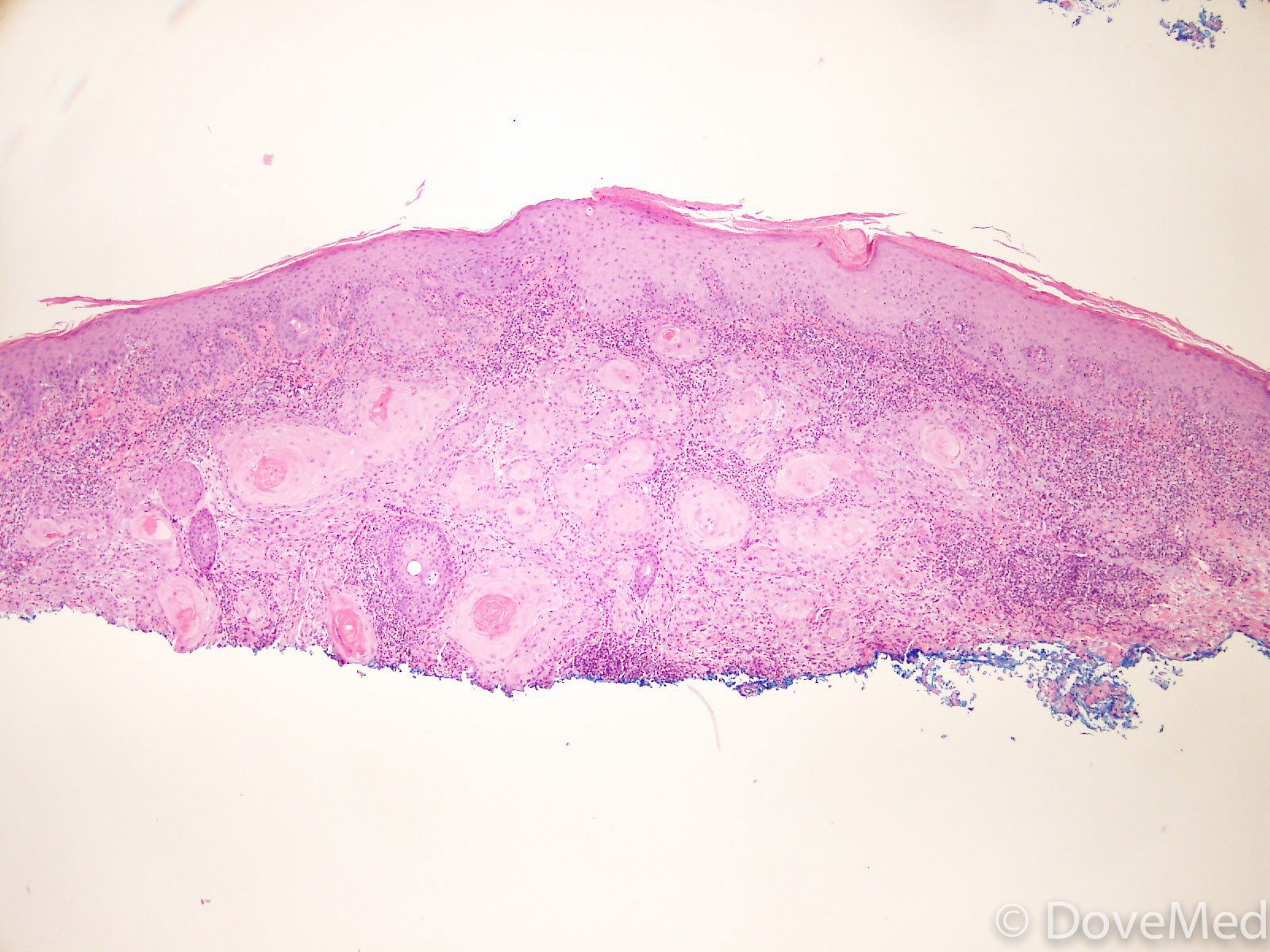 metastatic-squamous-cell-carcinoma-of-skin