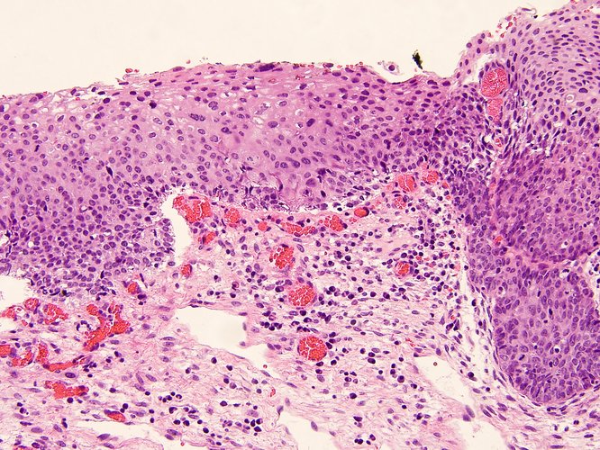 Squamous Cell Carcinoma Cervical Cancer