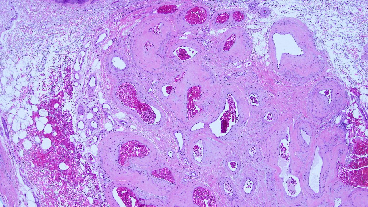 Hemangioma of Infancy