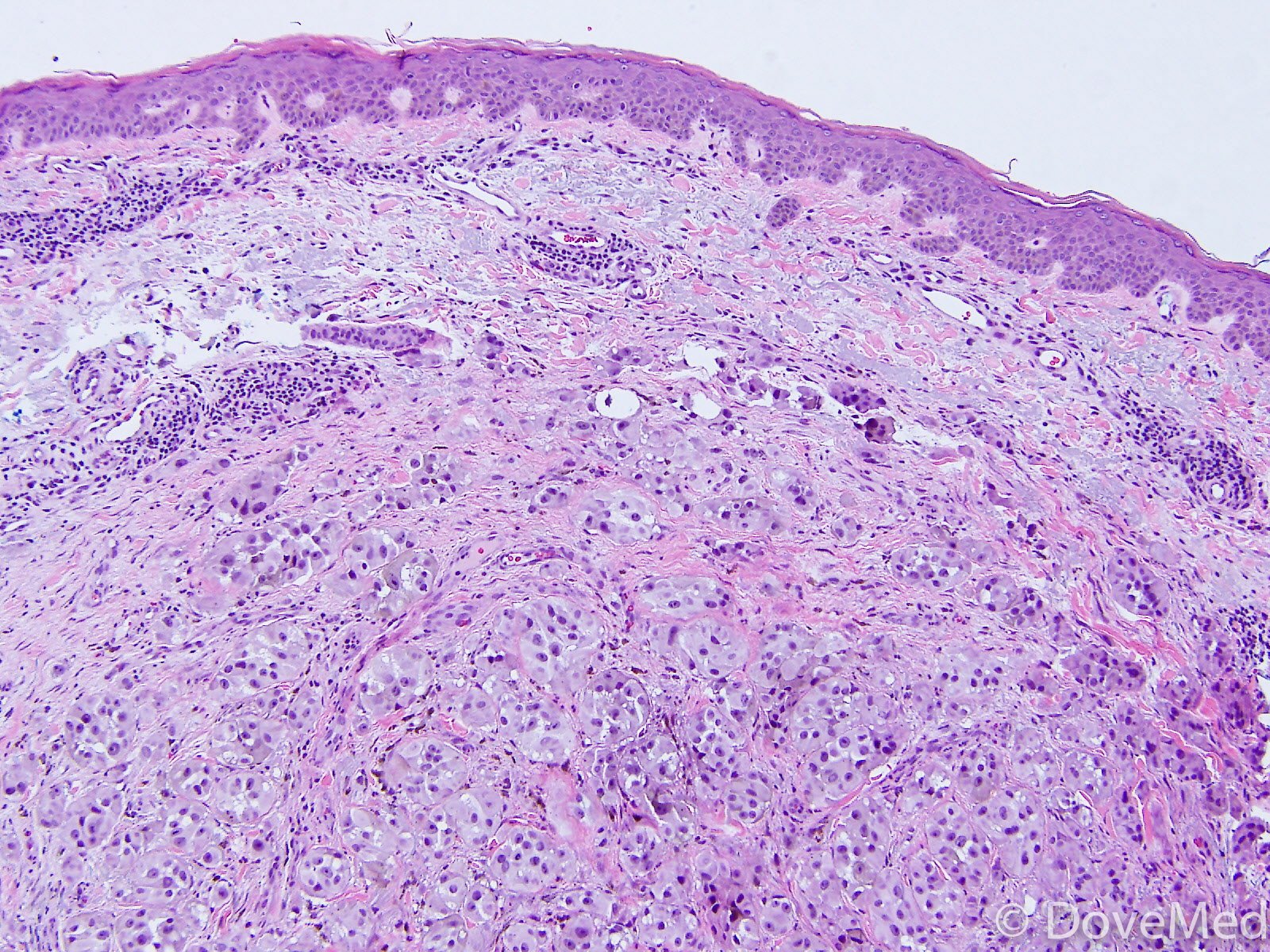 Nodular Malignant Melanoma