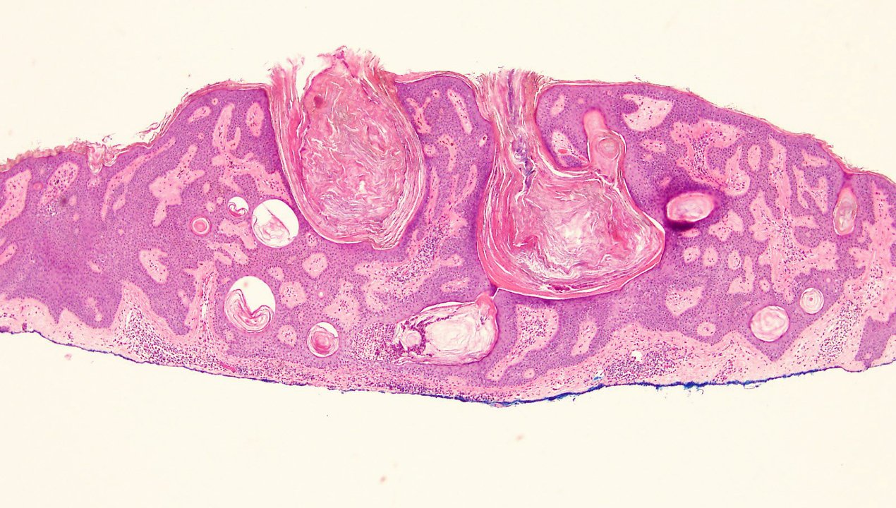 Seborrheic Keratosis Of Skin