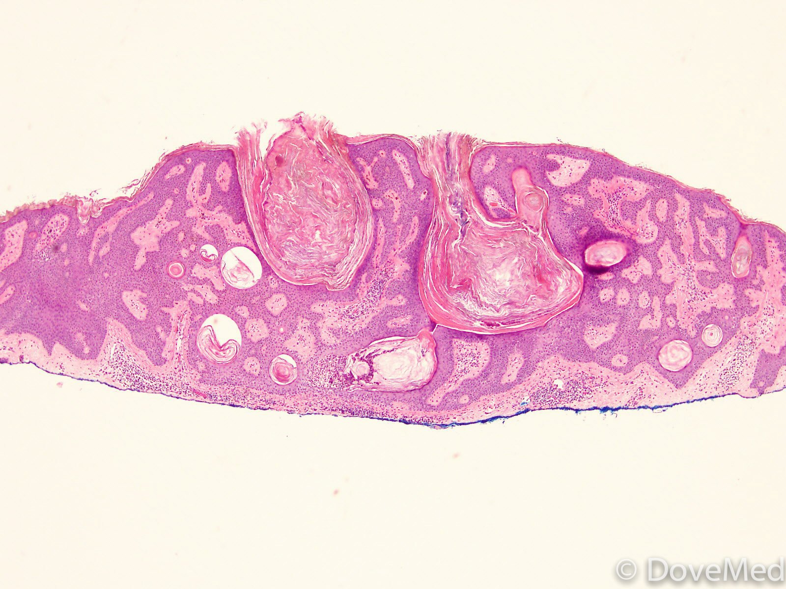 Кератоз гистология. Актинический дискератоз гистология. Черный акантоз гистология. Кератопапиллома гистология. Актинический дискератоз гистология.