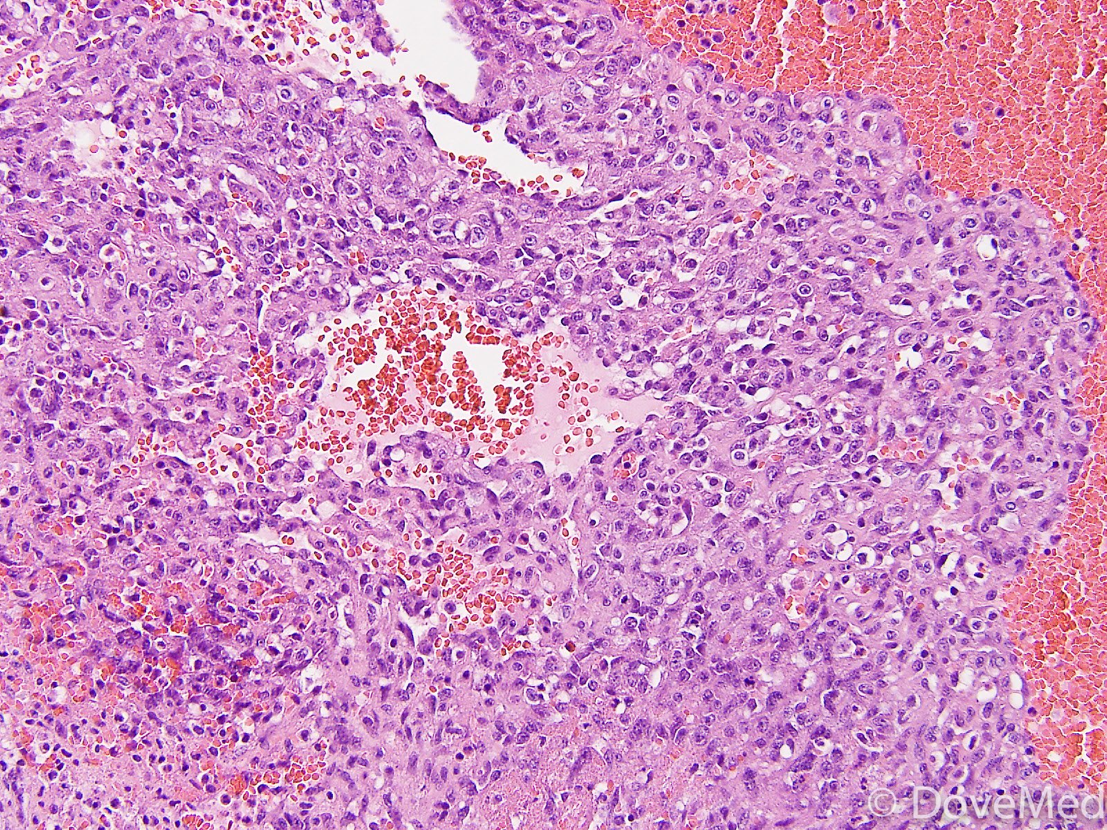 Angiosarcoma of Breast