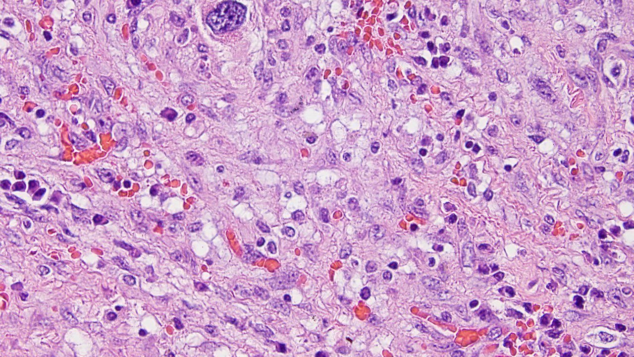 Primary Cardiac Angiosarcoma