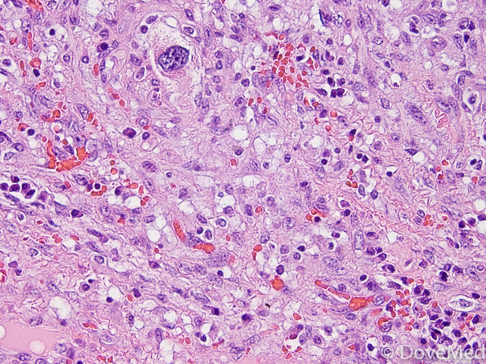 Primary Cardiac Angiosarcoma