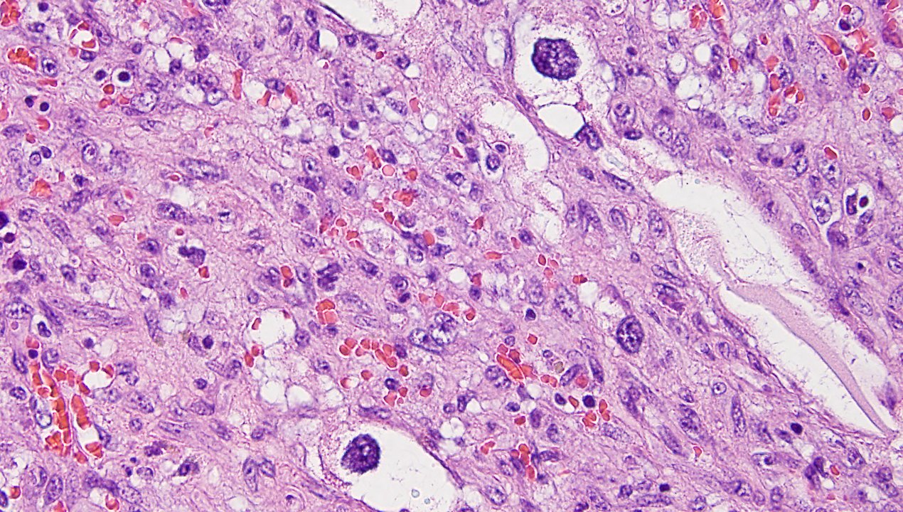 Angiosarcoma of Bone