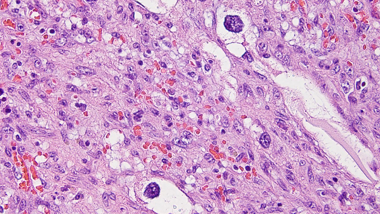 Epithelioid Angiosarcoma