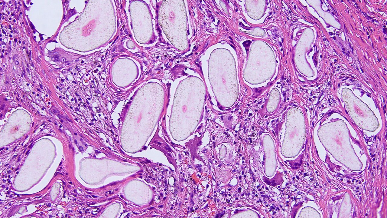 pilonidal-cyst-removal