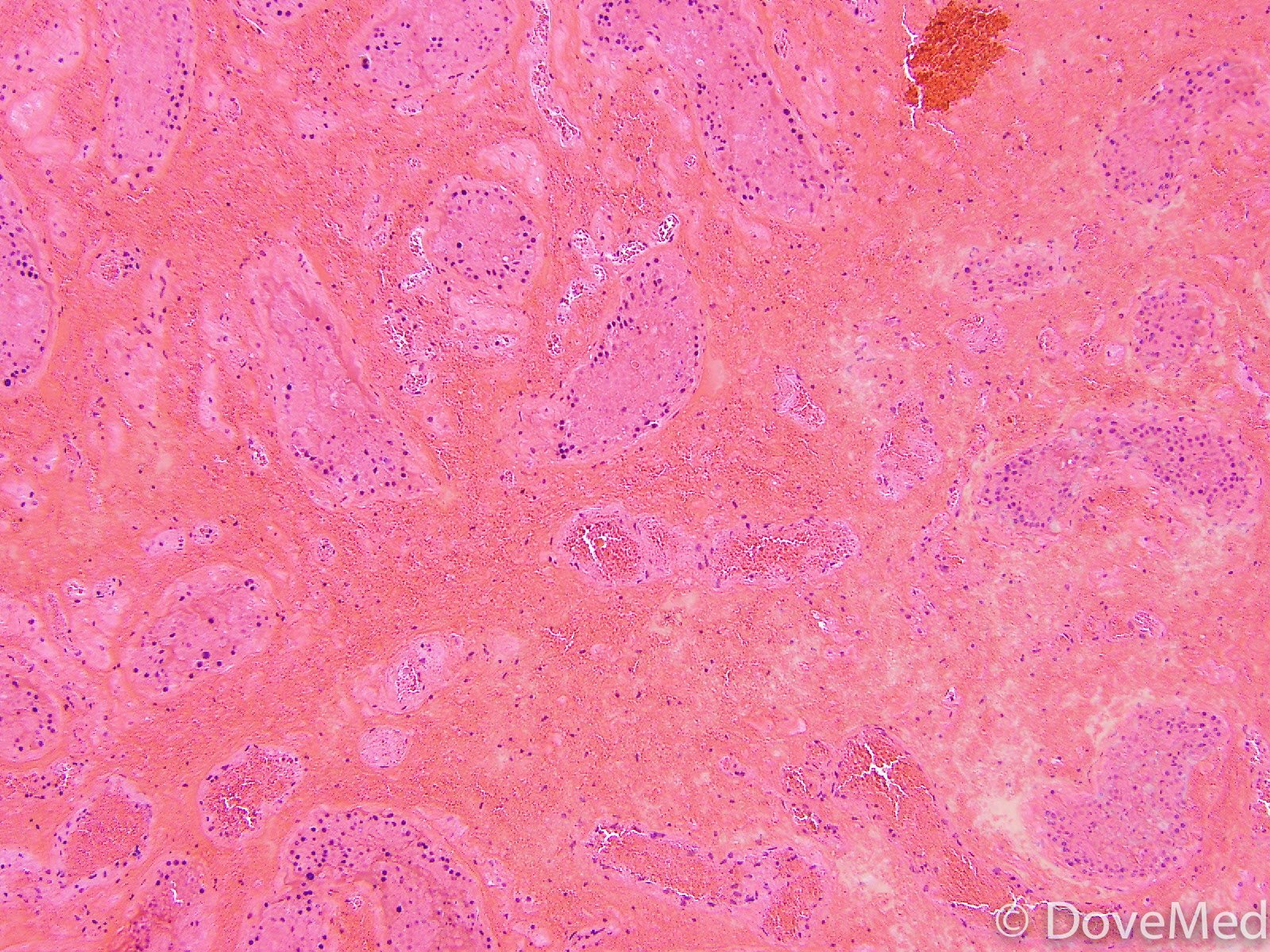 Testicular Torsion