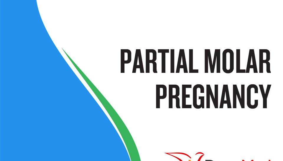 Partial Molar Pregnancy