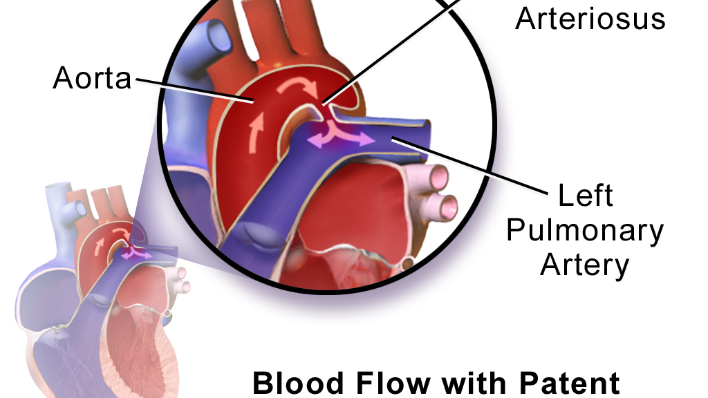 Patent Ductus Arteriosus (PDA)