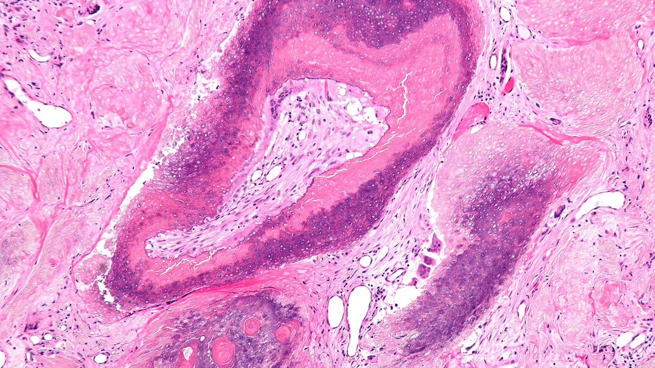 Pilomatricoma Histology