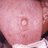 Primary stage syphilis sore (chancre) on the surface of a tongue.