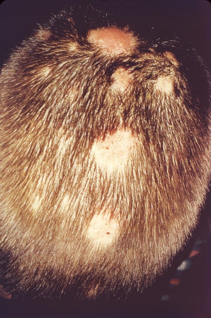 Foot Fungus Eliminated