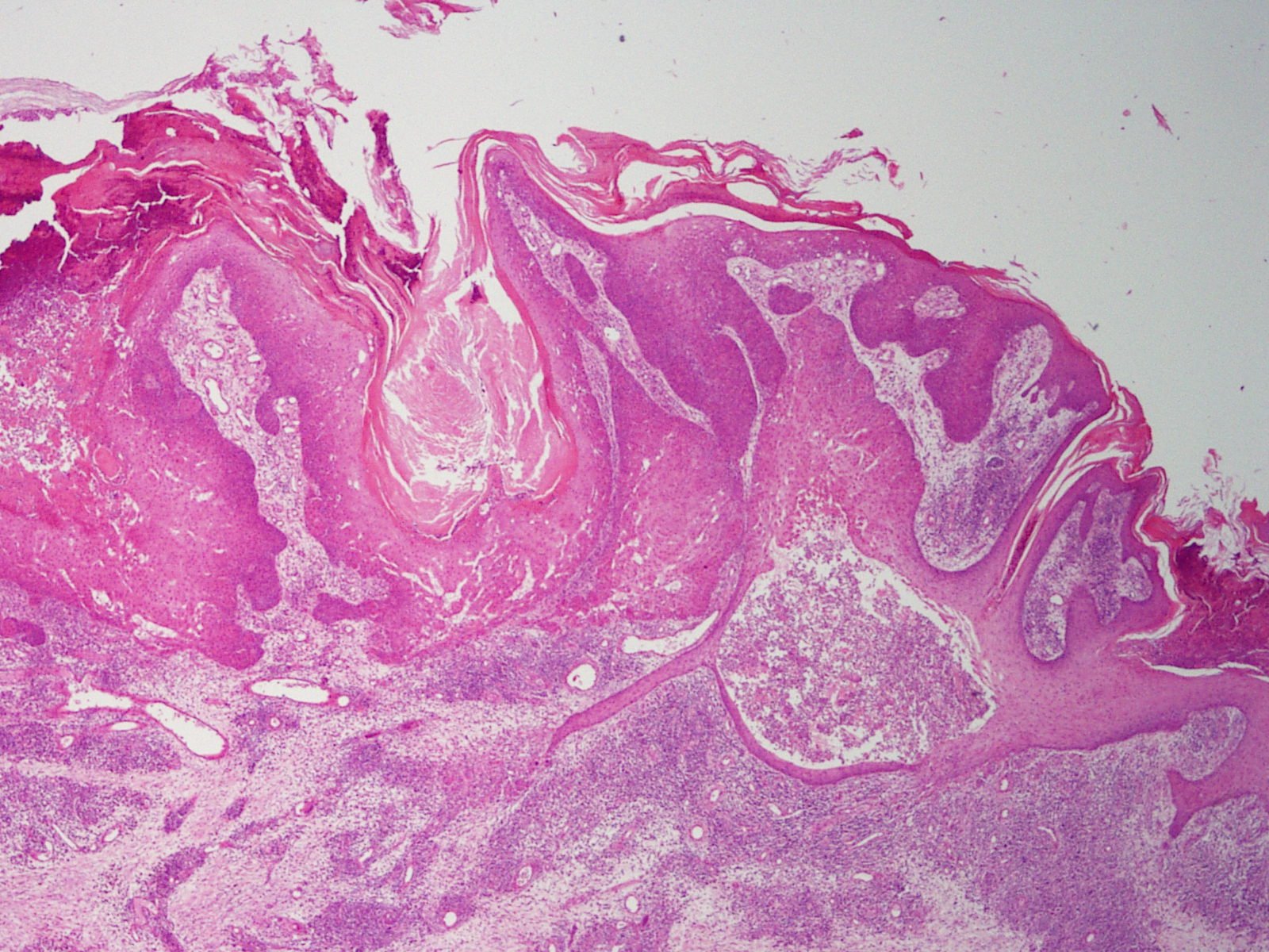 Tumor of Follicular Infundibulum