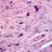Microscopic pathology image showing of the skin showing Pleomorphic fibroma. (20x).