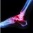 Inflammation in the ankle.