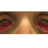 Acute hemorrhagic conjunctivitis with the eyelid pulled down for a more complete view.