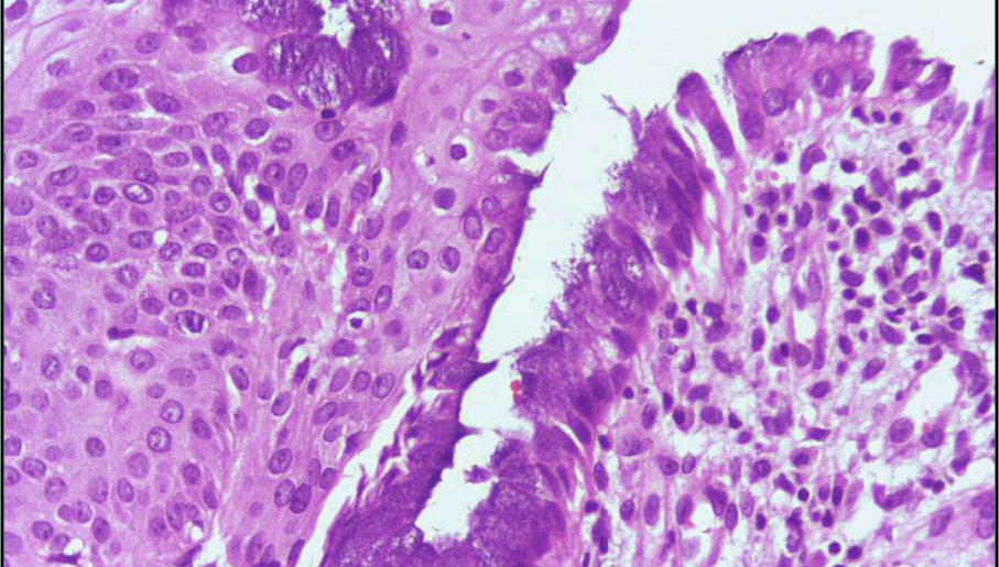 Squamous Metaplasia Of Uterine Cervix